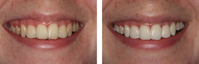 B1 Shade Results