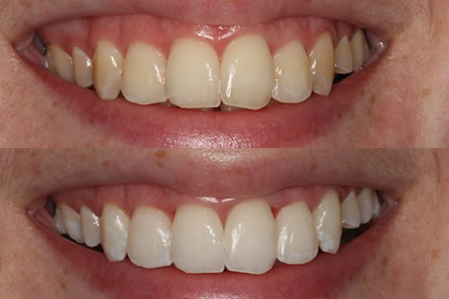 Custom Whitening Trays